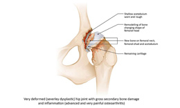 Severely dysplastic hip joint Image